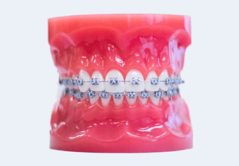 Clear Braces vs. Metal Braces - Dental Care of Northfield, Dentist, Northfield, ILDental Care of Northfield, Dentist