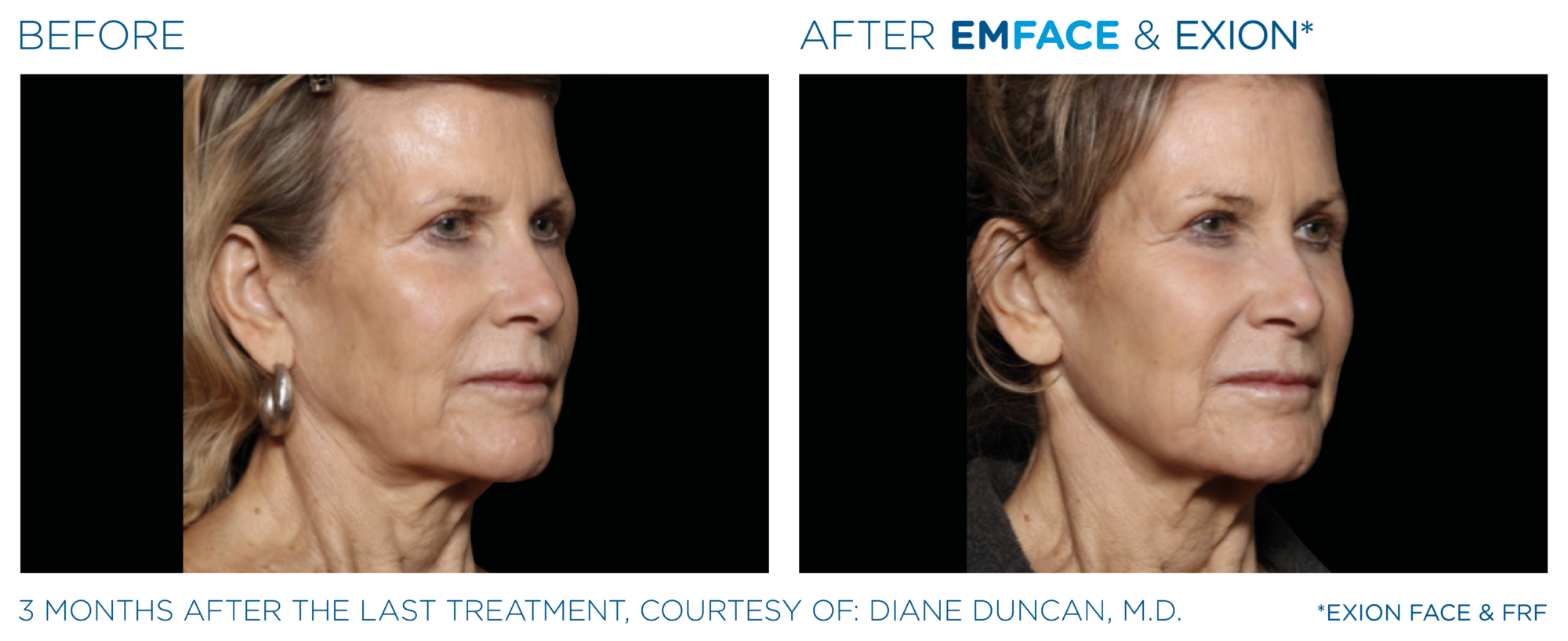 Emface before and after image.