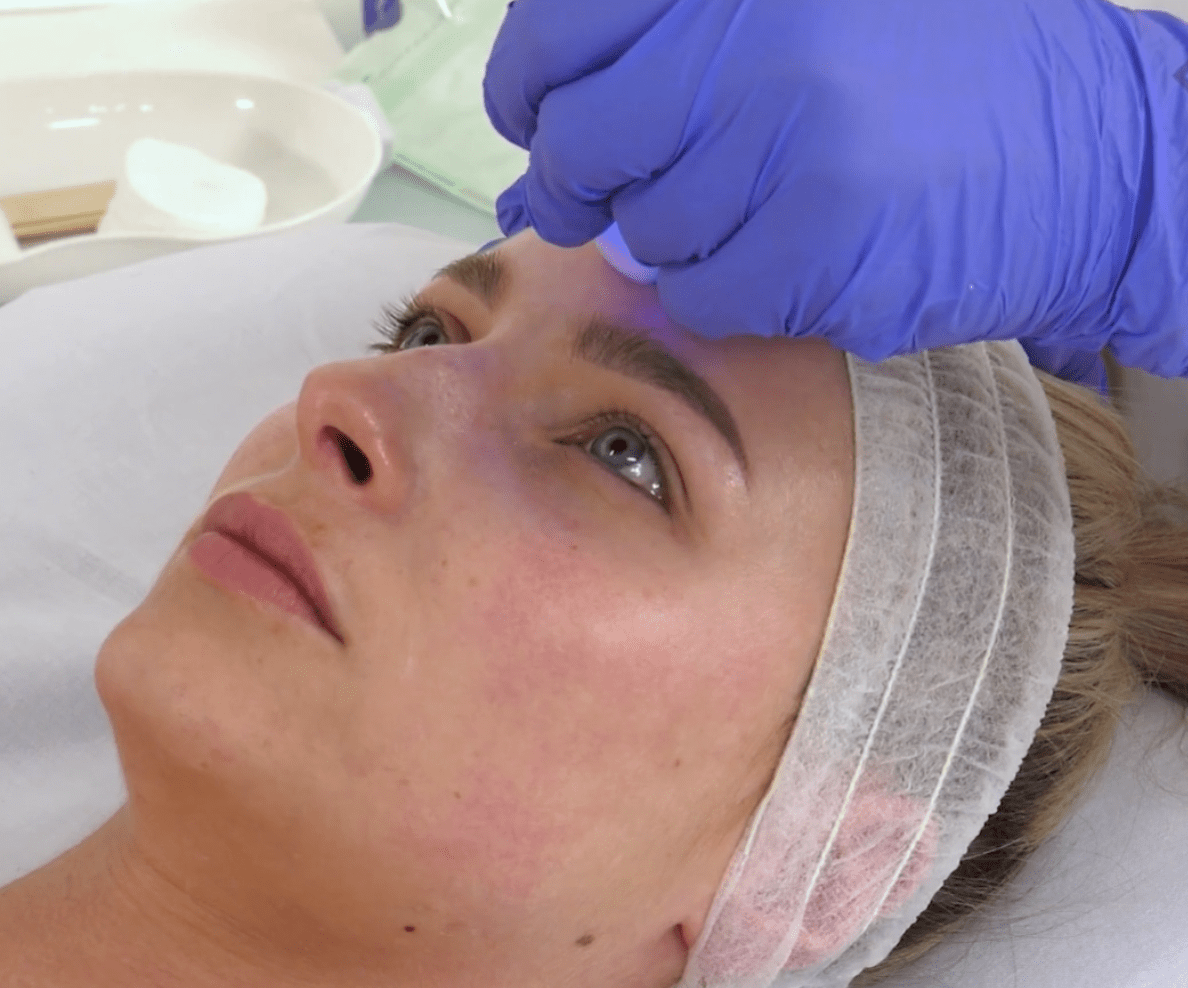 Radiofrequency Microneedling example